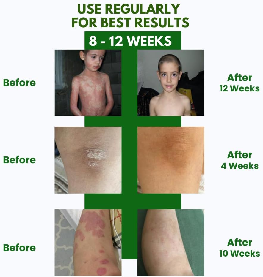 Psoriasis Cream – 3.4fl oz Topical Psoriasis Treatment with Coal Tar, Salicylic Acid, Tea Tree Oil, Aloe Vera – All-Natural Ingredients – Soothing and Moisturizing Coal Tar Psoriasis Cream - Image 2