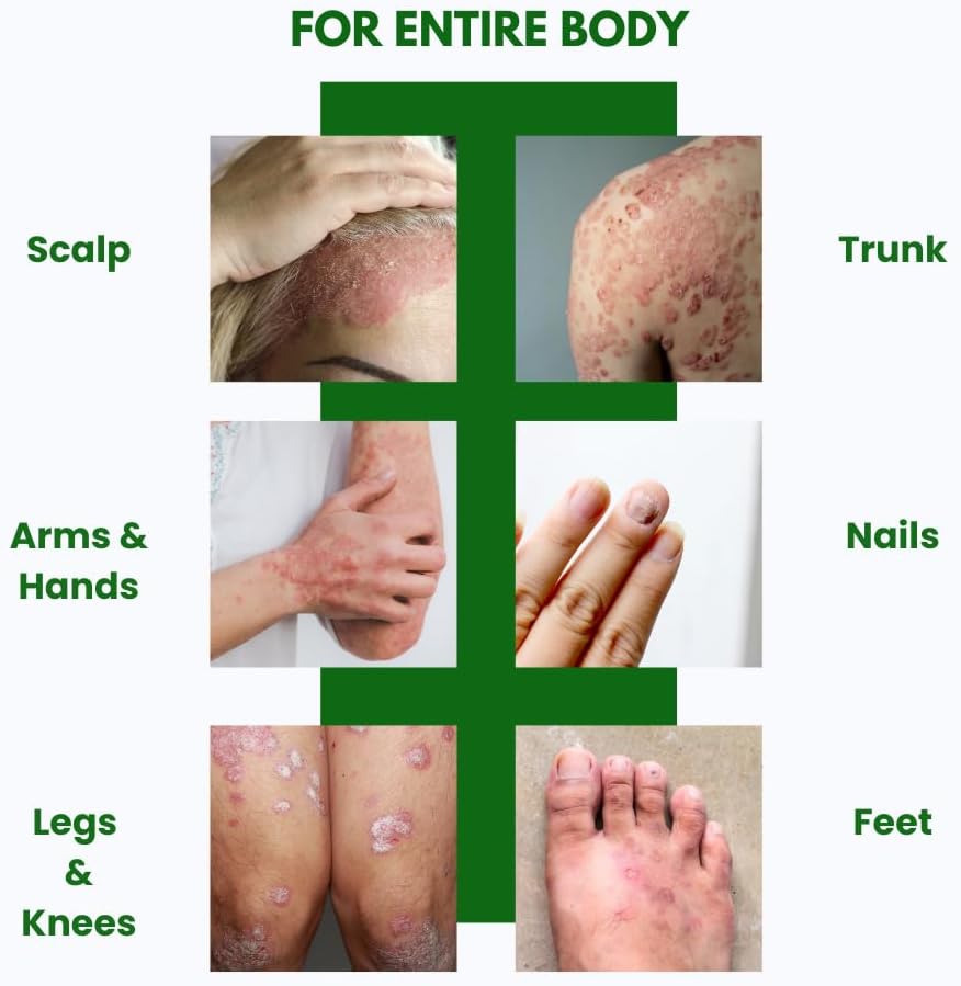 Psoriasis Cream – 3.4fl oz Topical Psoriasis Treatment with Coal Tar, Salicylic Acid, Tea Tree Oil, Aloe Vera – All-Natural Ingredients – Soothing and Moisturizing Coal Tar Psoriasis Cream - Image 3