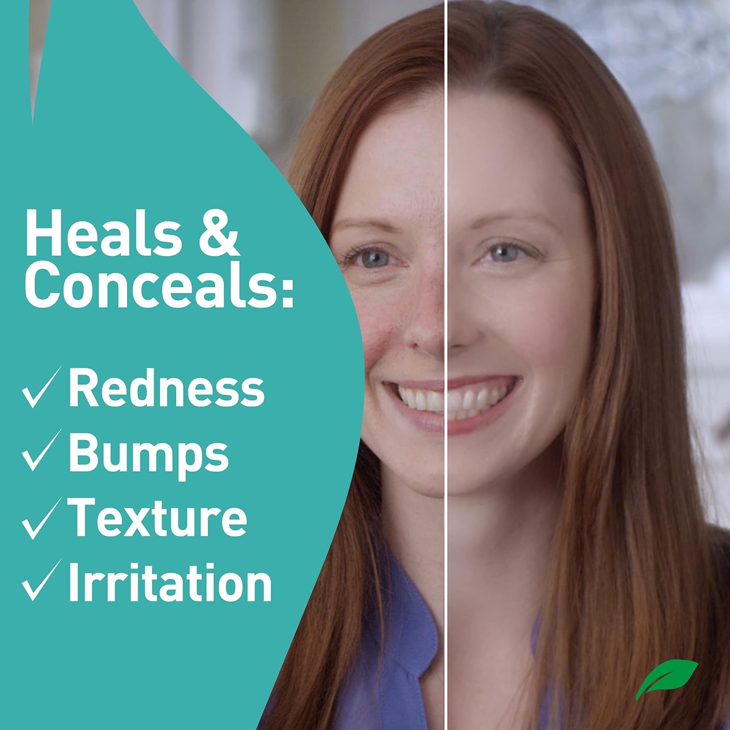 The Top 5 Rosacea Products for Skin Pain: Your Guide to Relief