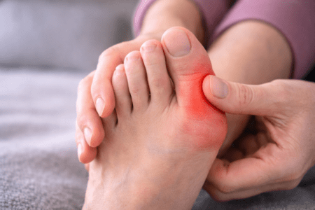 When a Bunion Decides to Run Your Life