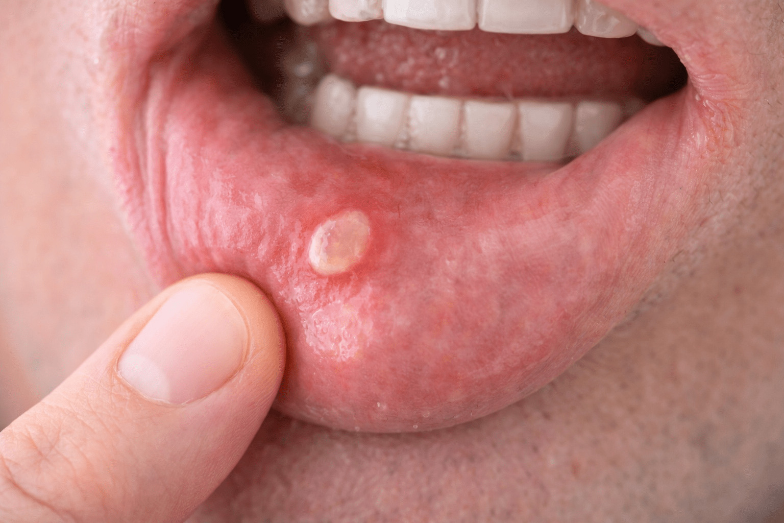 Canker Sore Illustration