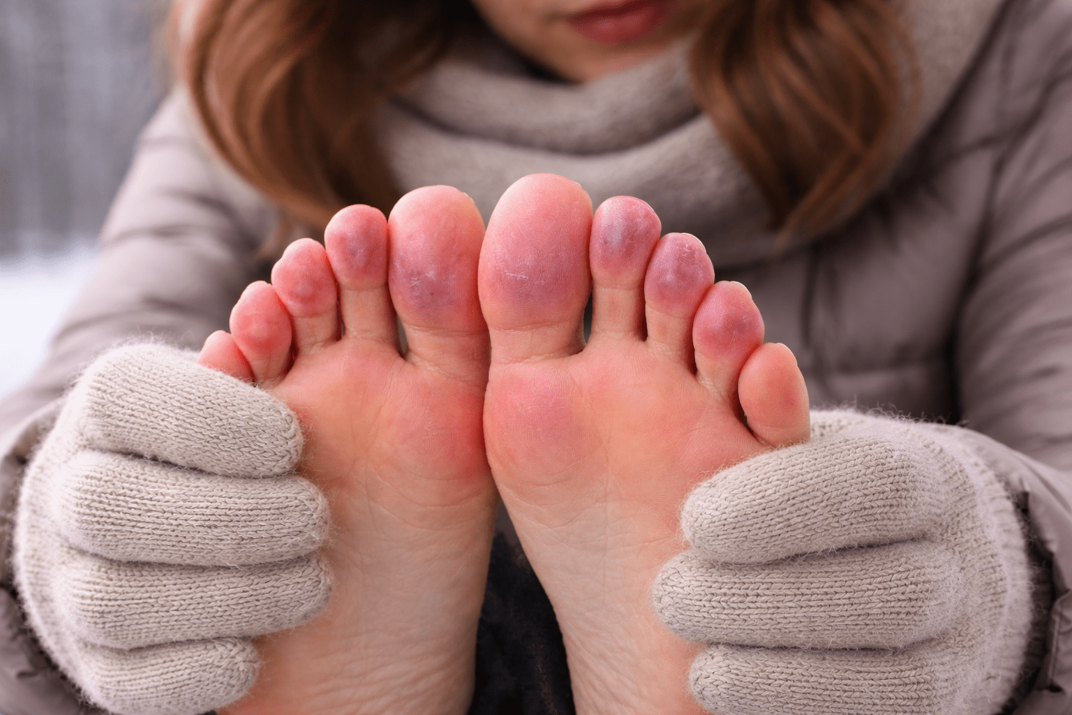Chilblains cold-related skin inflammation