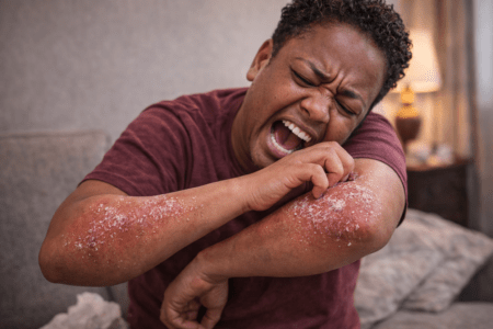 Psoriasis: When Your Skin Decides to Beef With You—Publicly