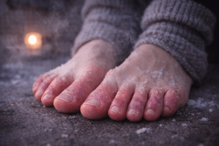 Chilblains: When Winter Looks at Your Toes and Says, “Fight Me.”