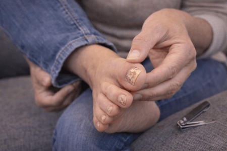Your Toenail Is a Petri Dish: A Rude, Hilarious, and Actually Useful Guide to Onychomycosis