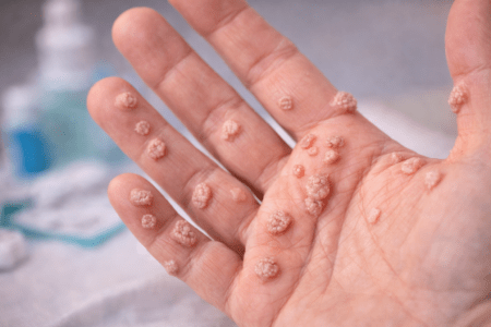 Warts: When Your Skin Decides to Start a Tiny, Unpaid Side Hustle